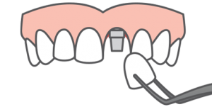 Illustration of front tooth porcelain crown ready to be attached to a dental implant fixture, filling a gap in a smile