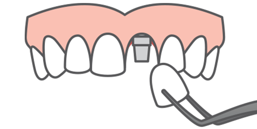 Illustration of front tooth porcelain crown ready to be attached to a dental implant fixture, filling a gap in a smile