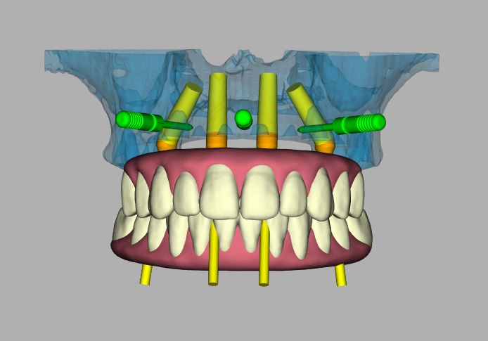 A digital, 3D image of an entire mouth for a dental implant treatment plan