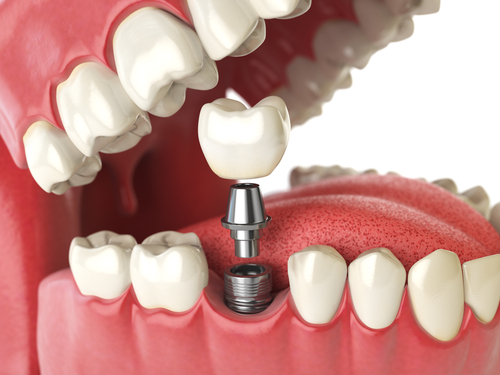 model of a dental implant being placed