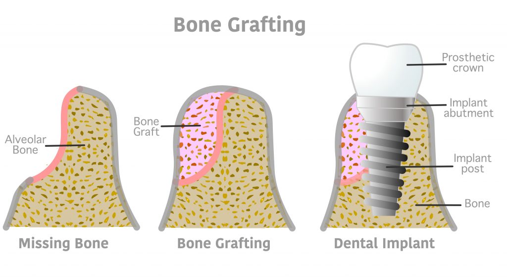 bone grafts