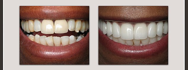 before and after implant supported dentures